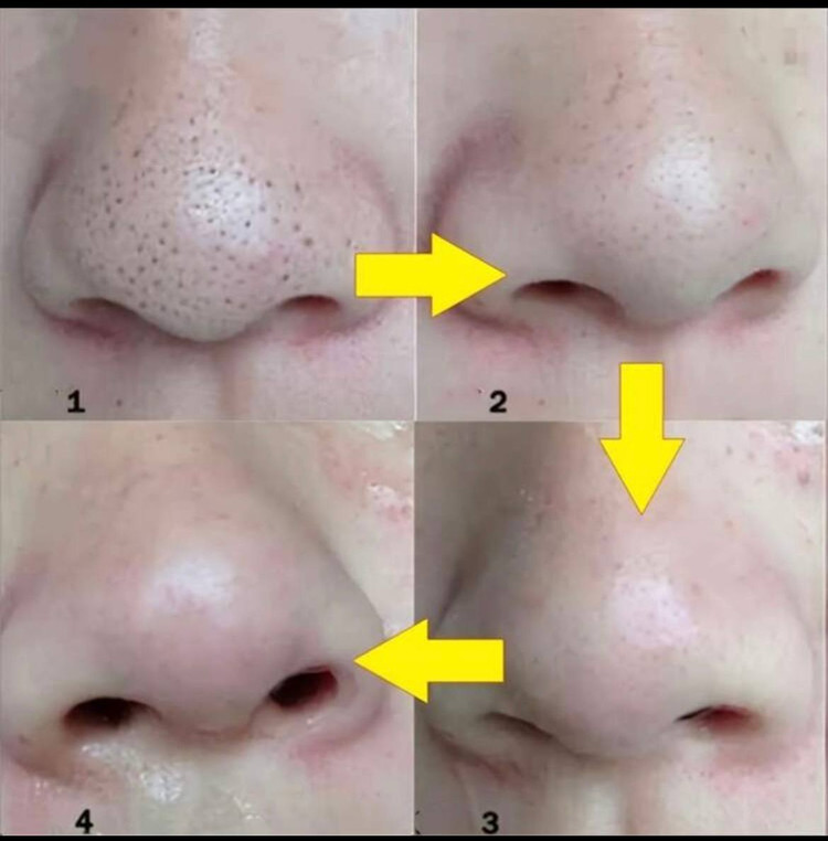 Nose strips